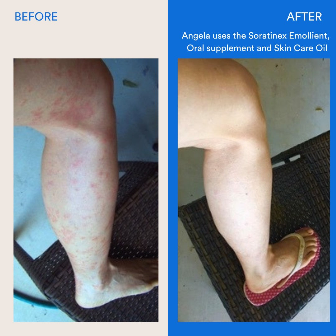 Soratinex Treatment Pack