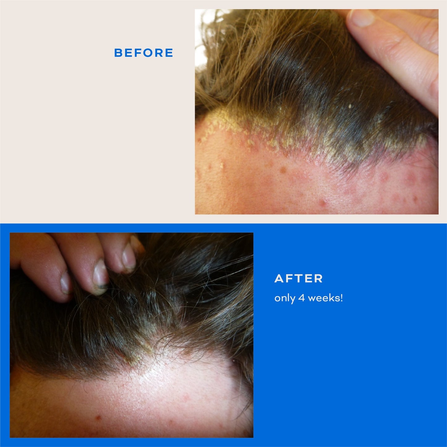 Scalp Psoriasis Bundle - Restock April