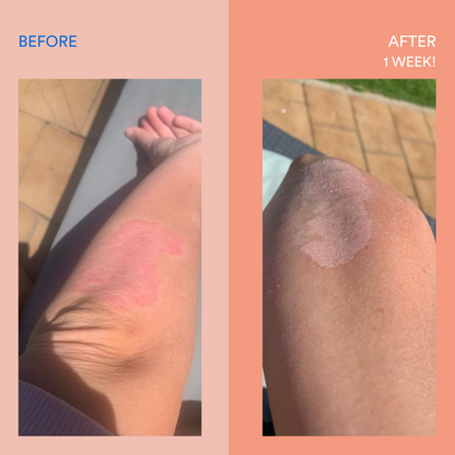 Soratinex Treatment Pack