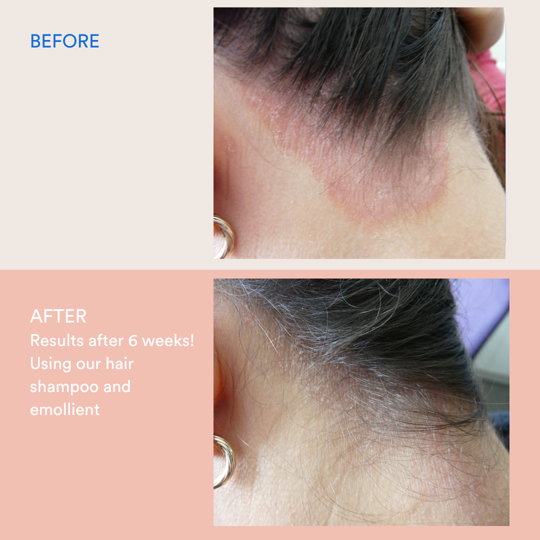 Scalp Psoriasis Bundle - Restock April